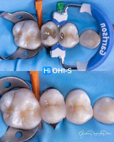 The Biomimetic Concept: Composite Restoration Protocols