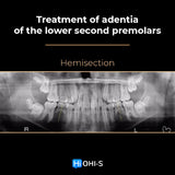 Early Orthodontic Treatment: When and How?