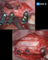 Predictable Sinus Lift