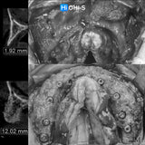 Bone Augmentation: Current Techniques