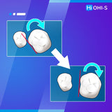 Aligners: Early Orthodontic Treatment