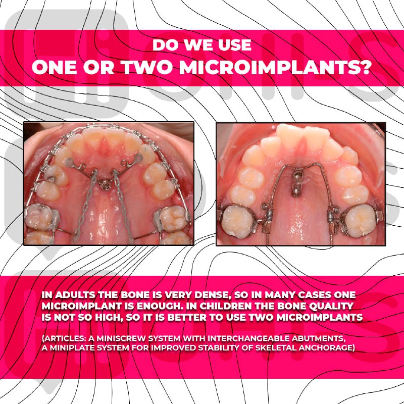 Challenging orthodontic cases: the use of skeletal anchorage