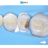 The Biomimetic Concept: Composite Restoration Protocols