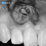 Apical Surgery: For Endodontists and Surgeons