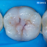 International Schools Working with Composite Restorations