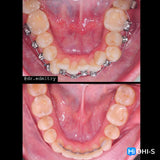 Damon 2.0. How to treat all common malocclusions