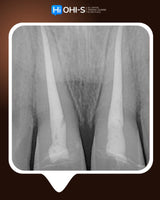 Dental Trauma Without Drama