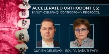 Accelerated orthodontics: Baruti-Demiraqi corticotomy protocol
