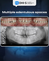 Missing Maxillary Lateral Incisors: Space Closure in All Malocclusions vs. Implants and Prosthetic Replacement