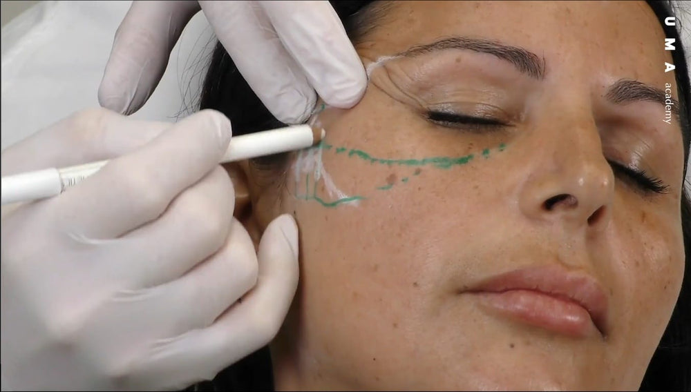 Advanced Filler Techniques: Combining CaHA, HA and hybrid fillers
