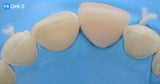 The Index Technique. No-prep worn dentition treatment