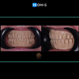 Removable dentures for dentists and technicians