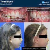 Orthodontics for Children and Teenagers