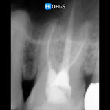 What’s NEW in Endodontics: From Anesthesia to Obturation