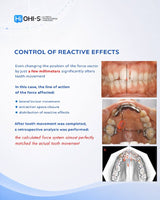 Biomechanics in Orthodontics