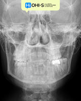 Aligners and Microimplants: Combined Protocol