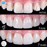 Composite Veneers, All Restorative Techniques