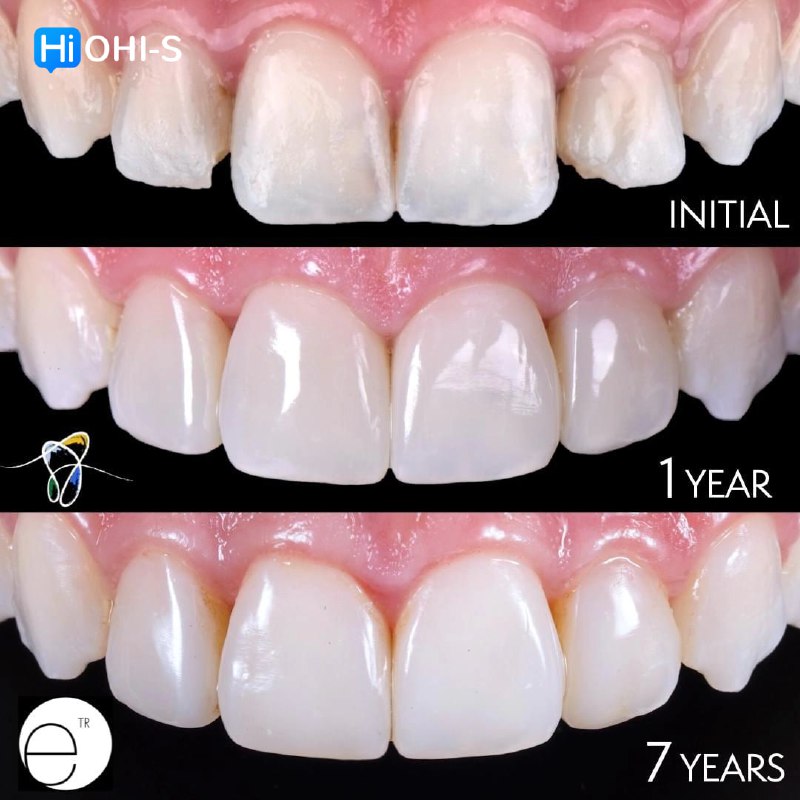Composite Veneers, All Restorative Techniques