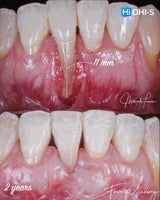 Advanced Periodontal Treatment: Surgical and Non‑Surgical Approaches