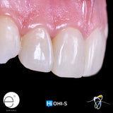 Composite Veneers, All Restorative Techniques