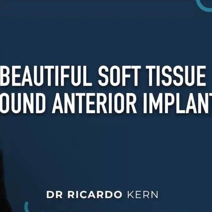 Beautiful Soft Tissue Around Anterior Implants