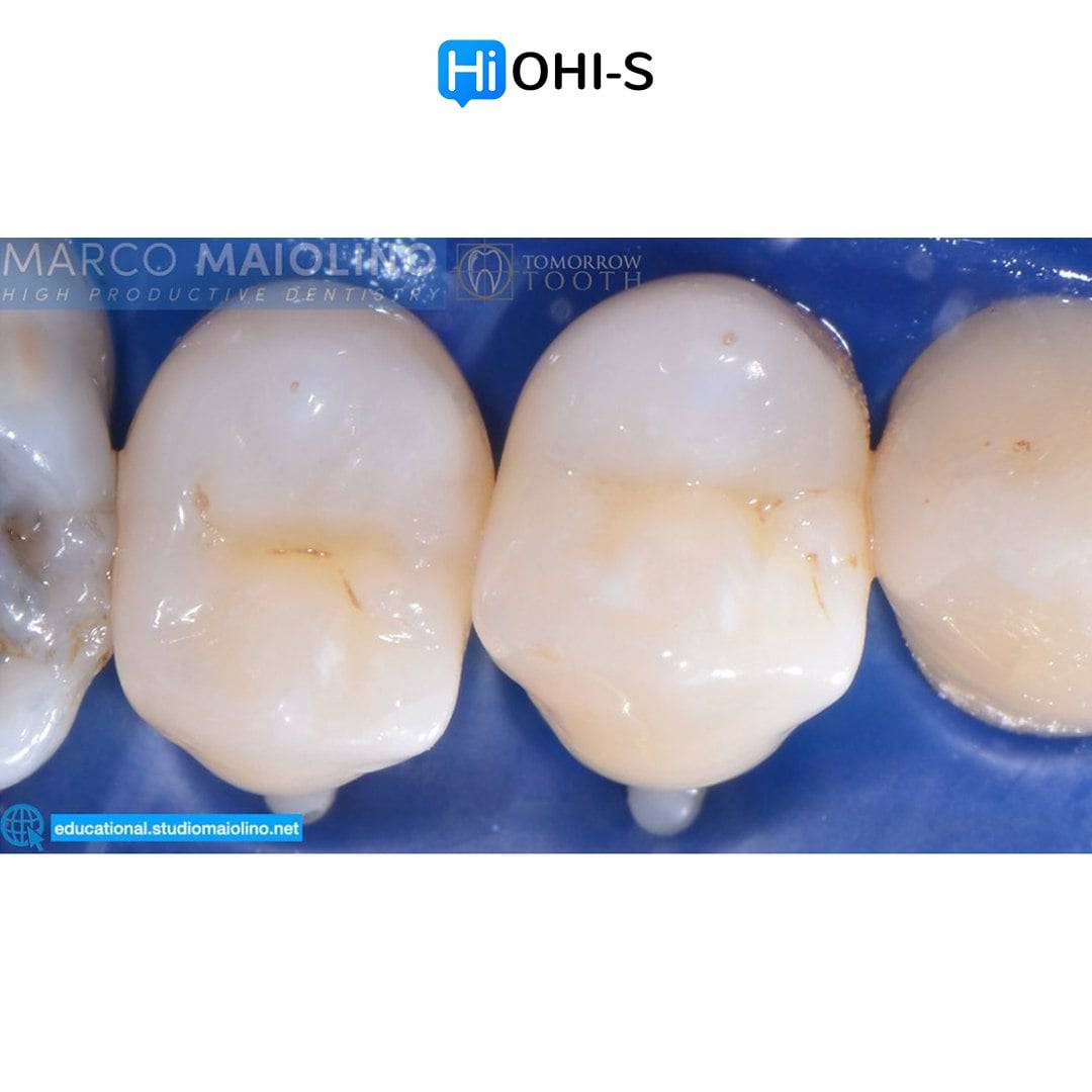 Bioclear Dental Restoration