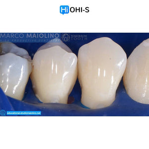 Bioclear Dental Restoration