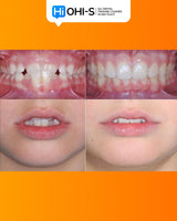 Early Orthodontic Treatment: When and How?