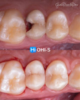 The Biomimetic Concept: Composite Restoration Protocols
