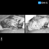 Predictable Sinus Lift