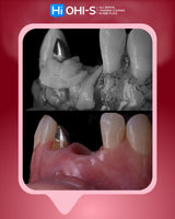 Soft Tissue Plastic Surgery around Implants