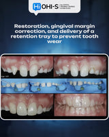 Missing Maxillary Lateral Incisors: Space Closure in All Malocclusions vs. Implants and Prosthetic Replacement