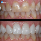 Anterior Veneers: Digital Manufacturing Protocols for Functional and Aesthetic Restorations