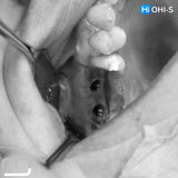 Predictable Sinus Lift