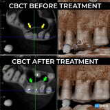Apical Surgery: For Endodontists and Surgeons
