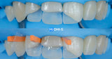 International Schools Working with Composite Restorations