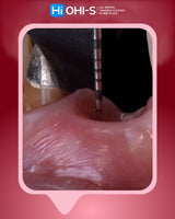 Soft Tissue Plastic Surgery around Implants