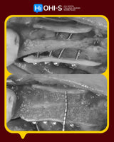 Bone Augmentation: Current Techniques
