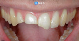 International Schools Working with Composite Restorations