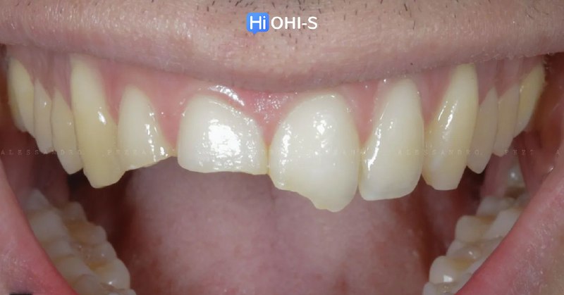 International Schools Working with Composite Restorations