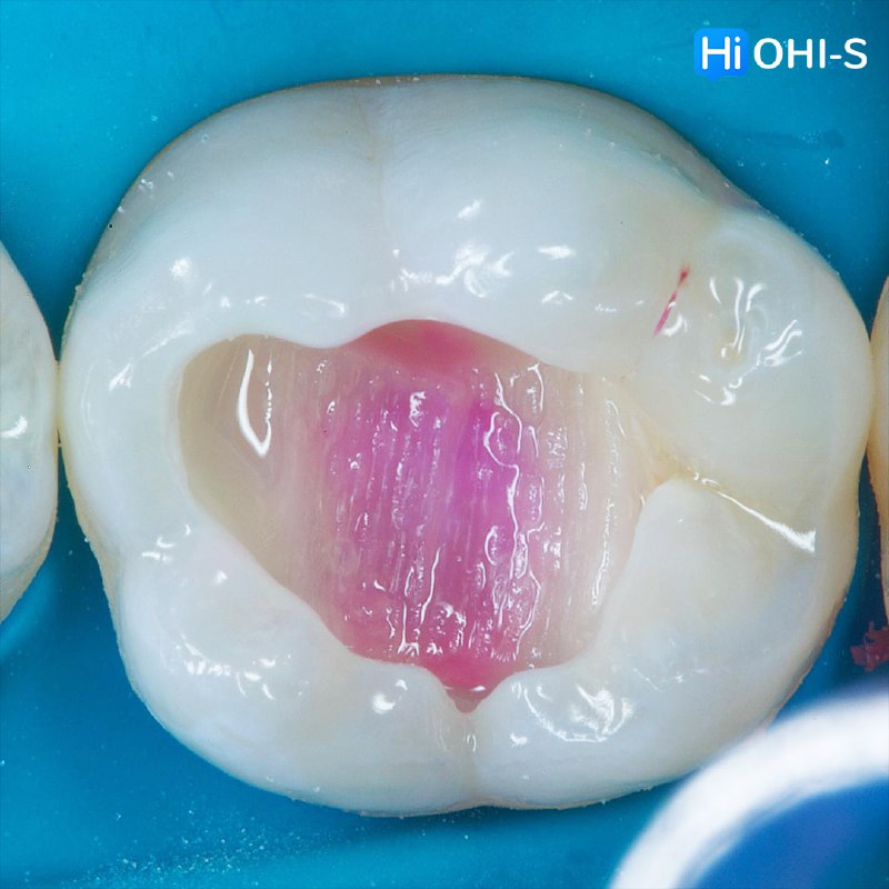 International Schools Working with Composite Restorations
