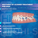 Aligners: Early Orthodontic Treatment