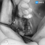 Predictable Sinus Lift