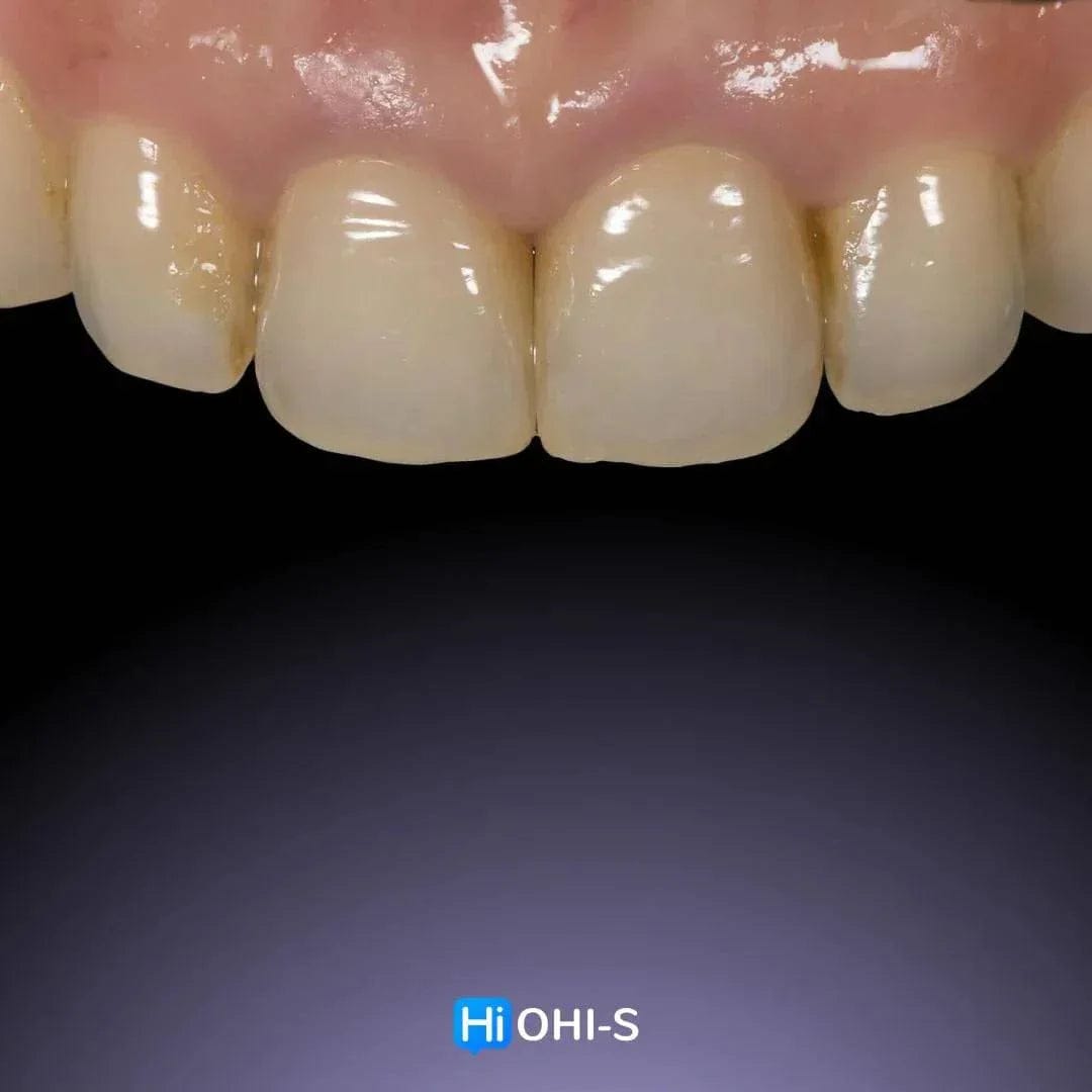 Ceramic Layering: Protocols of the World’s Leading Schools