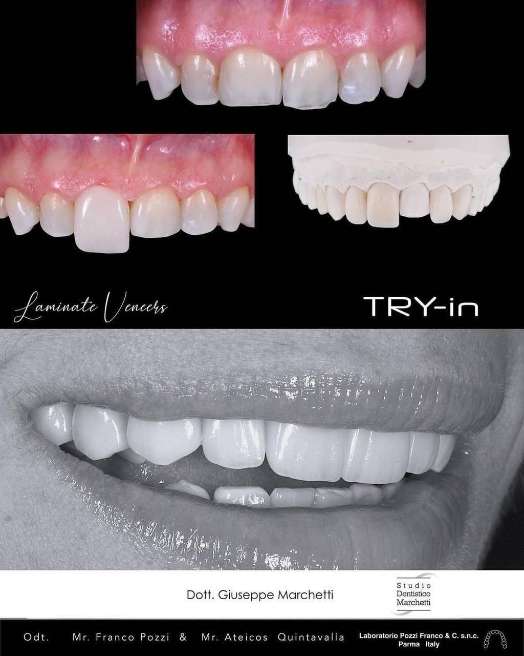 Ceramic Restorations:  Veneers, Inlays, Crowns