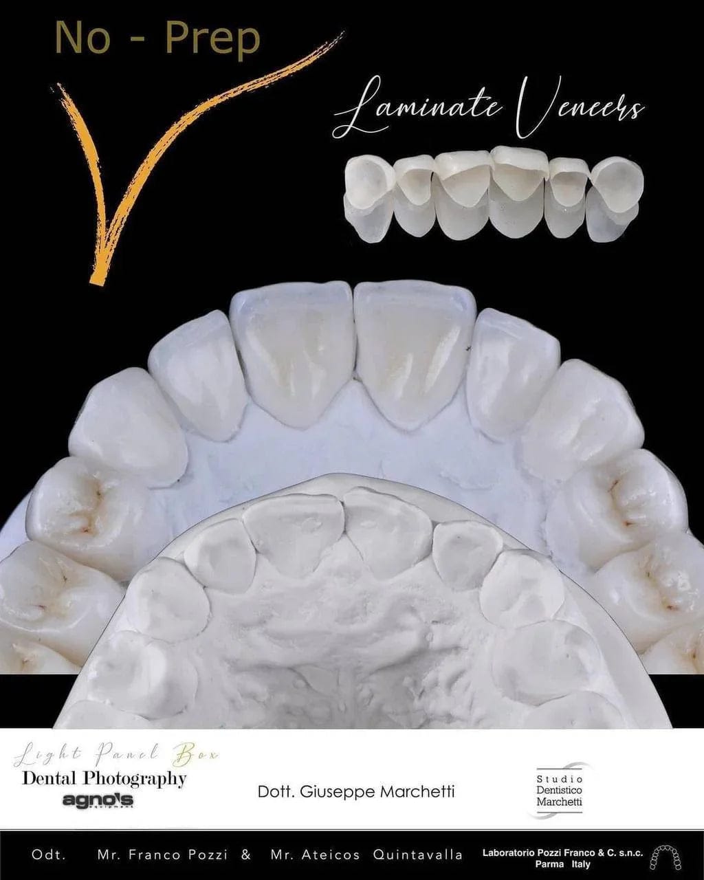Ceramic Restorations:  Veneers, Inlays, Crowns
