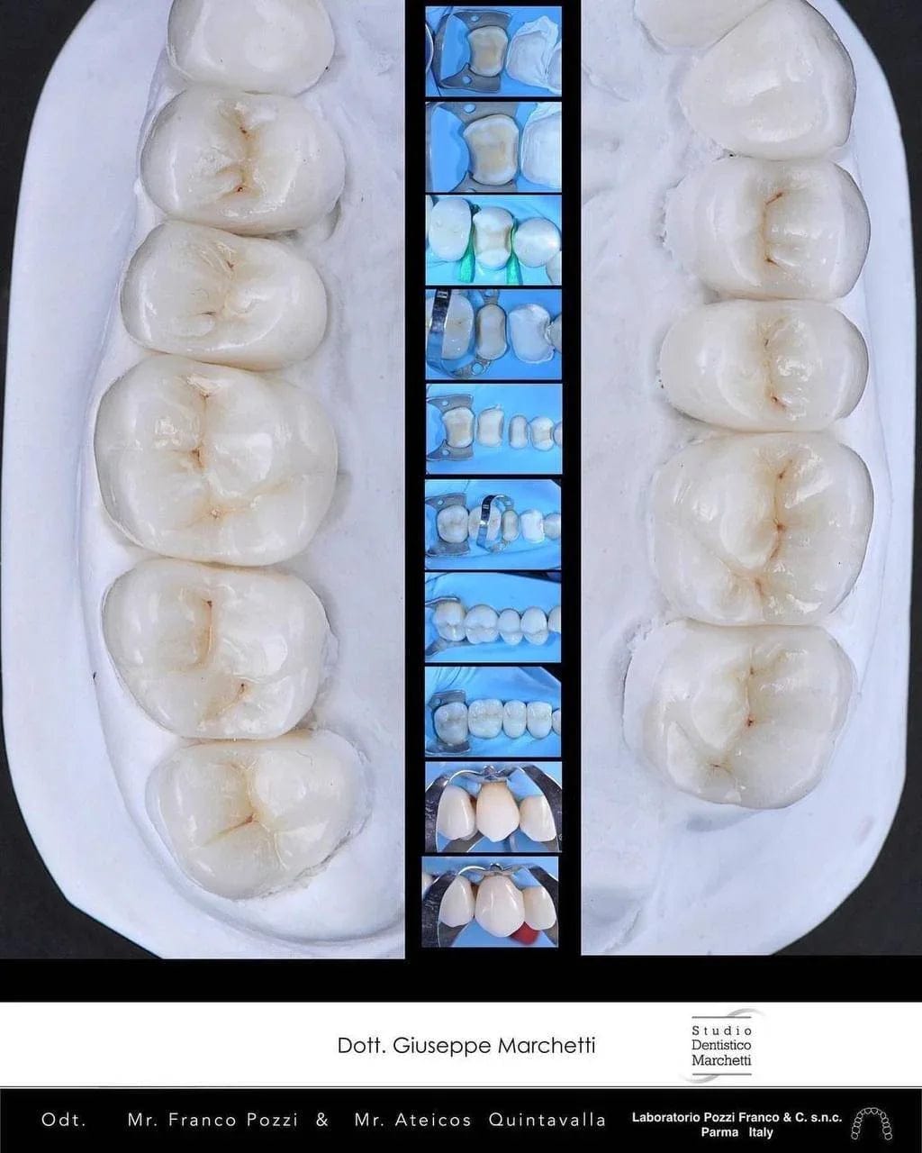 Ceramic Restorations:  Veneers, Inlays, Crowns
