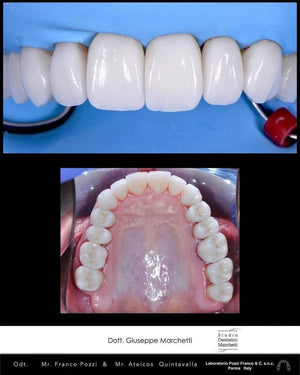 Ceramic Restorations:  Veneers, Inlays, Crowns