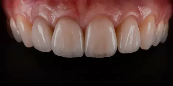 Ceramic Veneers: Interdisciplinary Approach and Updated Protocols