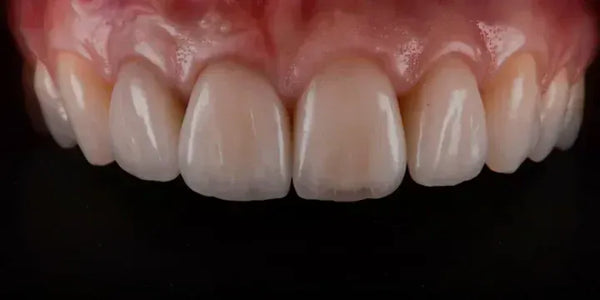 Ceramic Veneers: Interdisciplinary Approach and Updated Protocols